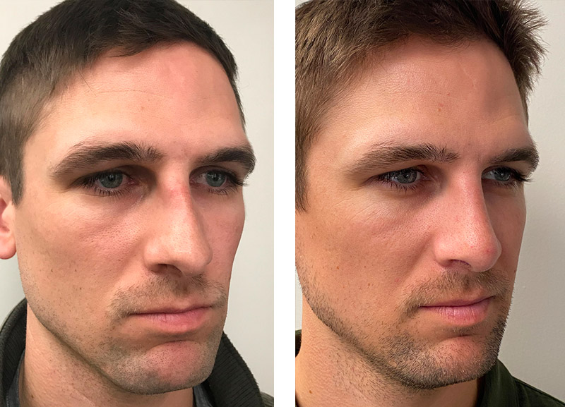 Choosing a Nose Shape and Nose Size when Considering Rhinoplasty