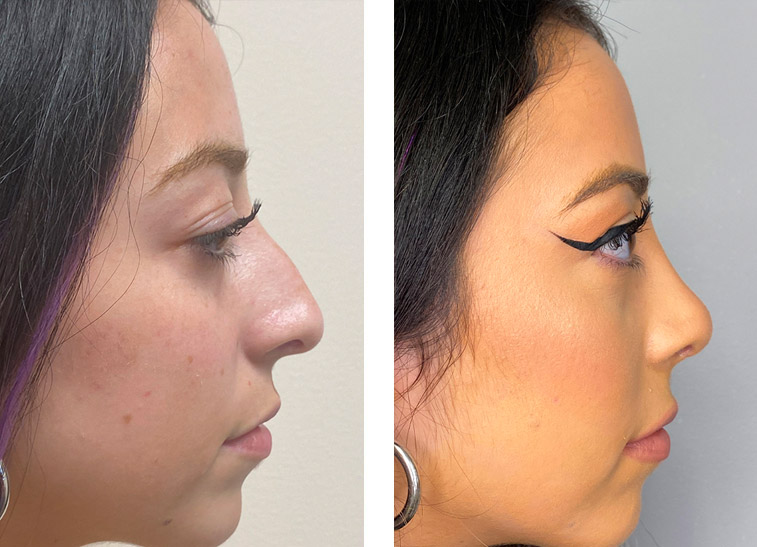 bad rhinoplasty before and after