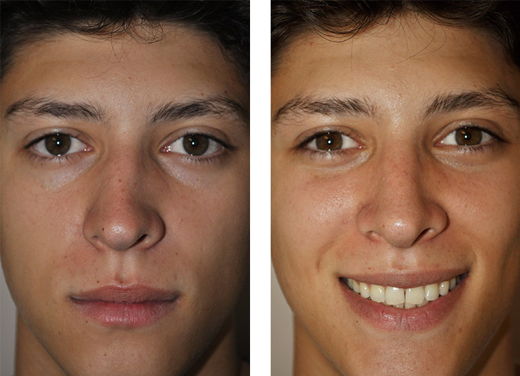 deviated septum surgery before and after